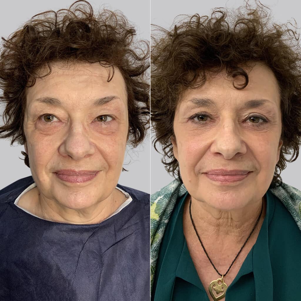 La Bl Pharoplastie Paris Chirurgie Esth Tique Des Paupi Res Dr Hayot