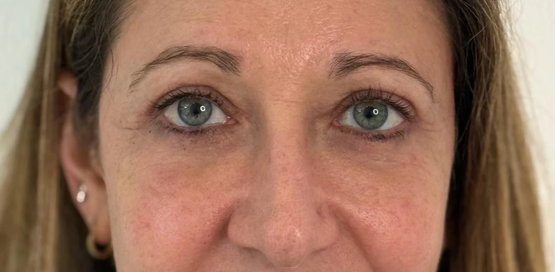Après : Blépharoplastie d’addition des quatre paupières