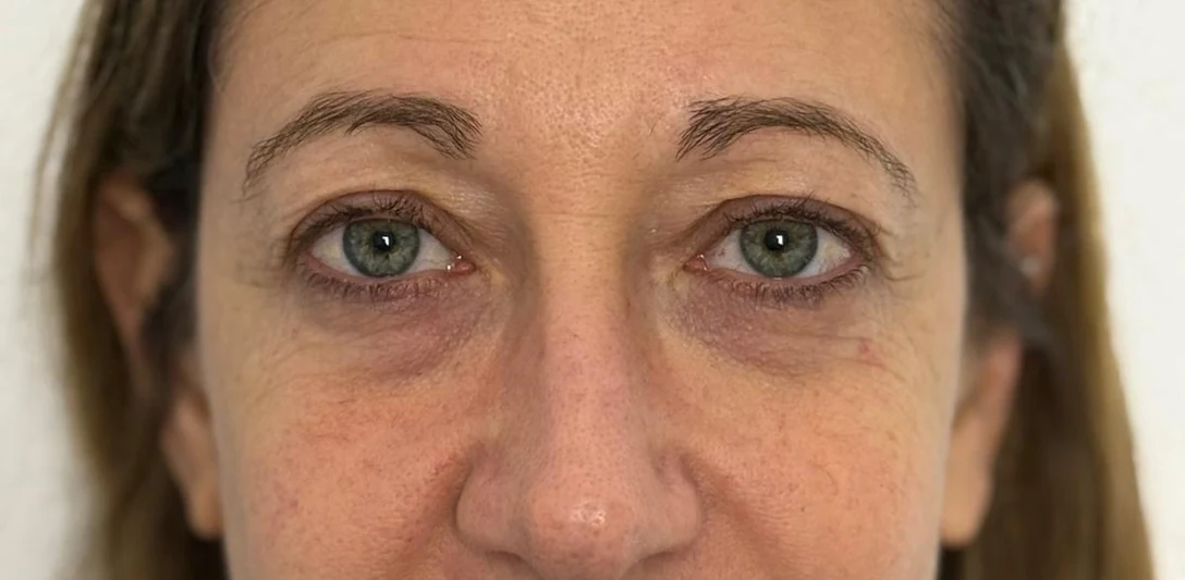 Avant : Blépharoplastie d’addition des quatre paupières