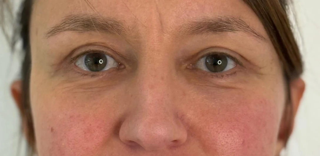 After: Addition blepharoplasty, case 01