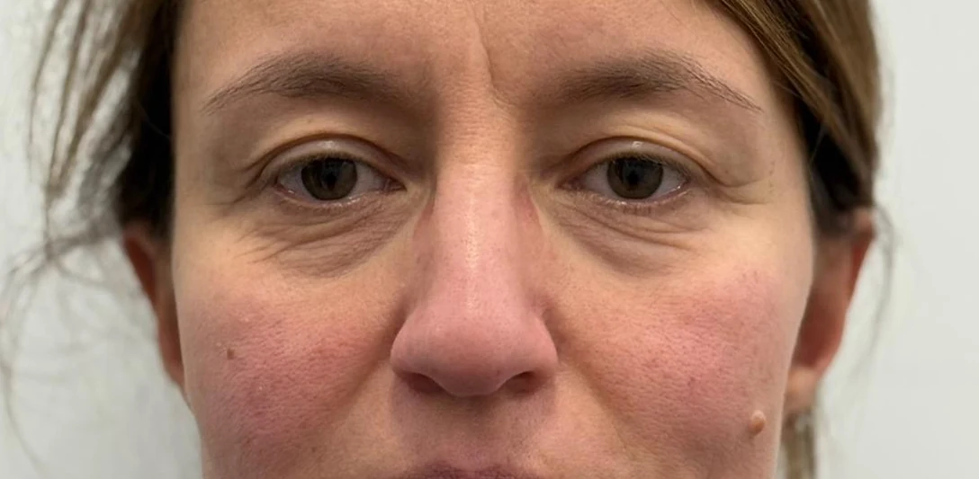 Before: Addition blepharoplasty, case 01
