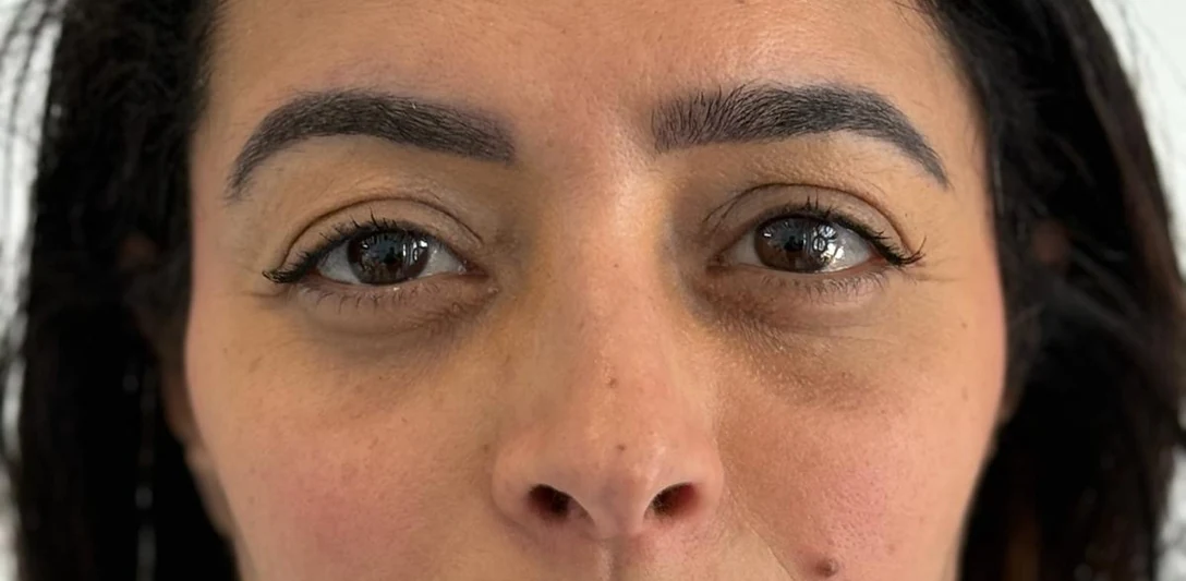 After: Restorative lower blepharoplasty · front view
