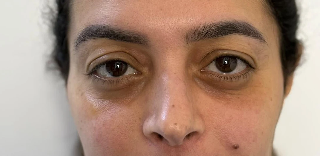 Before: Restorative lower blepharoplasty · front view