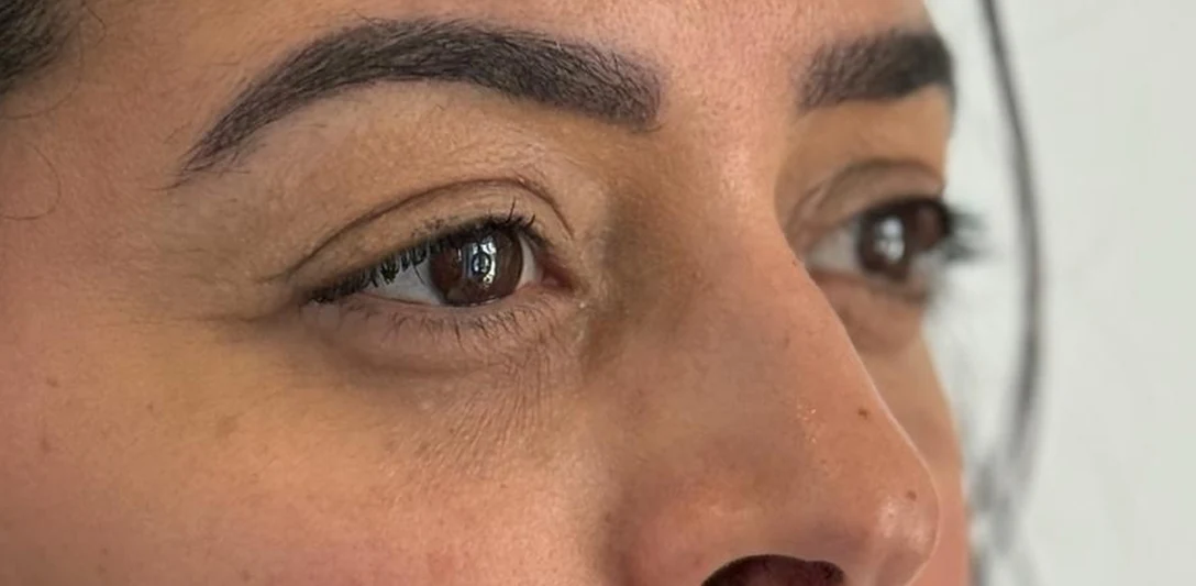 After: Restorative lower blepharoplasty · three-quarter view