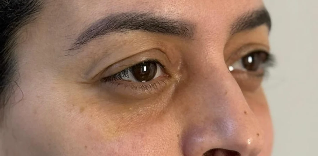 Before: Restorative lower blepharoplasty · three-quarter view