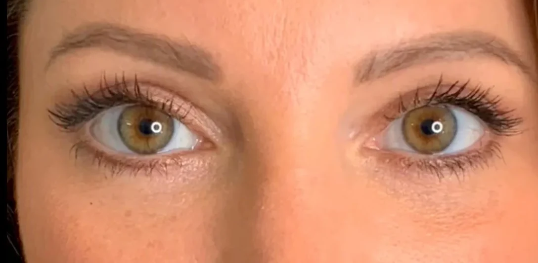 After: Upper blepharoplasty