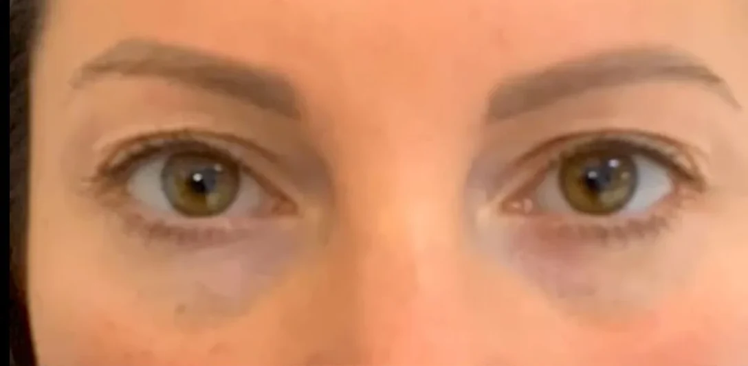 Before: Upper blepharoplasty
