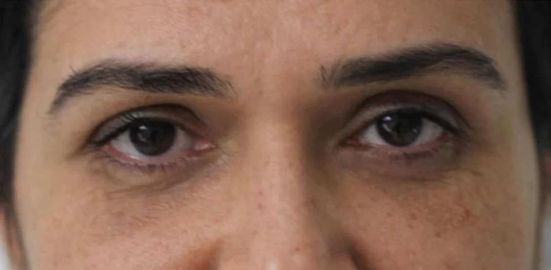 After: Pigmented dark circles treated with nanofat