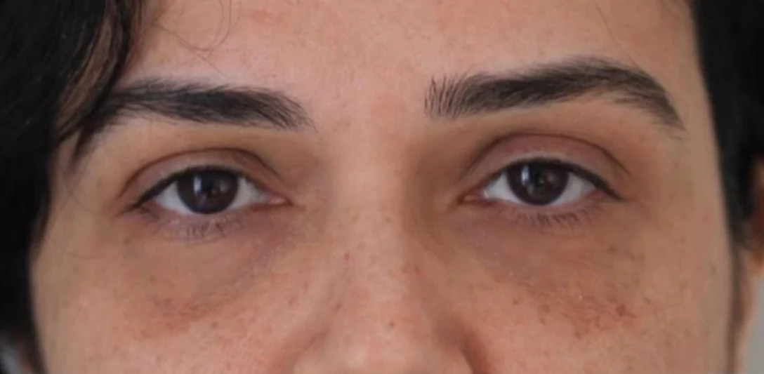 Before: Pigmented dark circles treated with nanofat