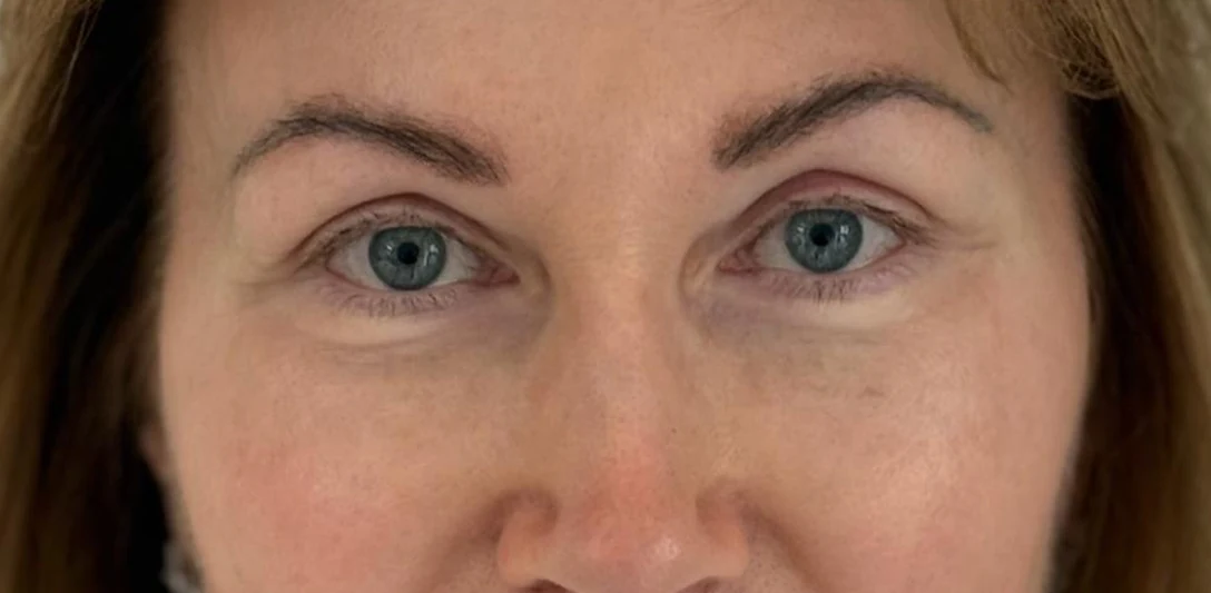 After: Endoscopic brow lift, case 2