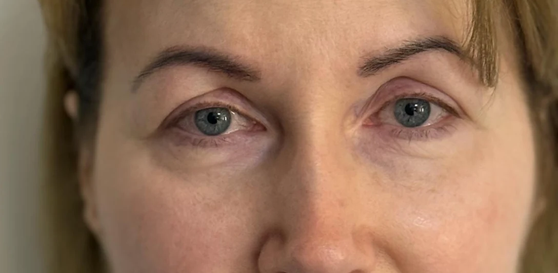 Before: Endoscopic brow lift, case 2