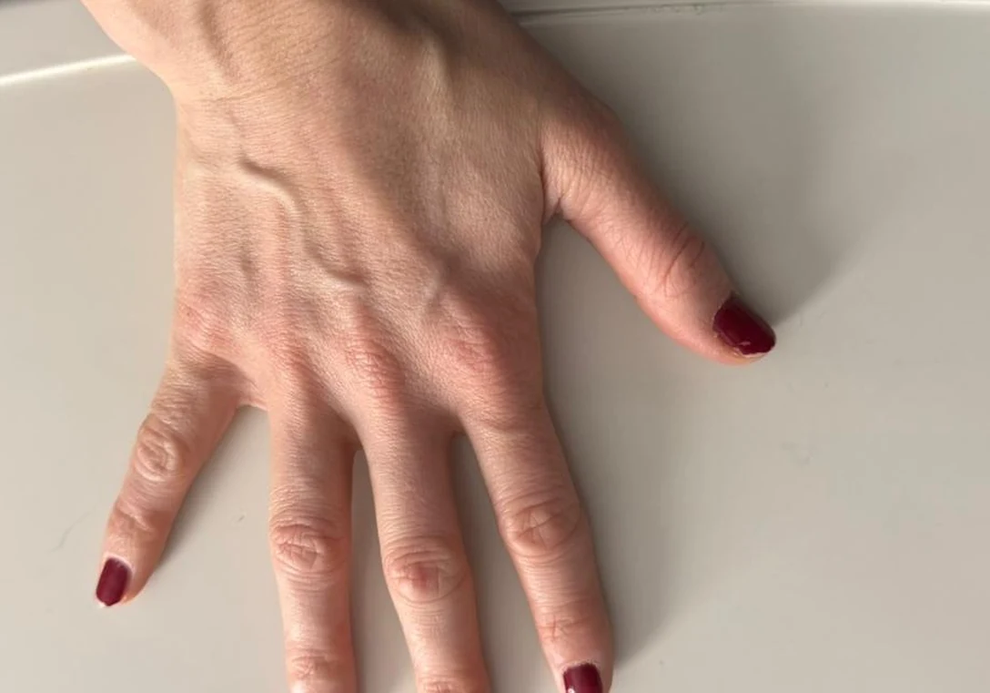 Avant : Liposculture des mains · main droite