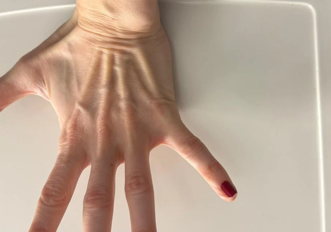 Avant : Liposculture des mains · main gauche