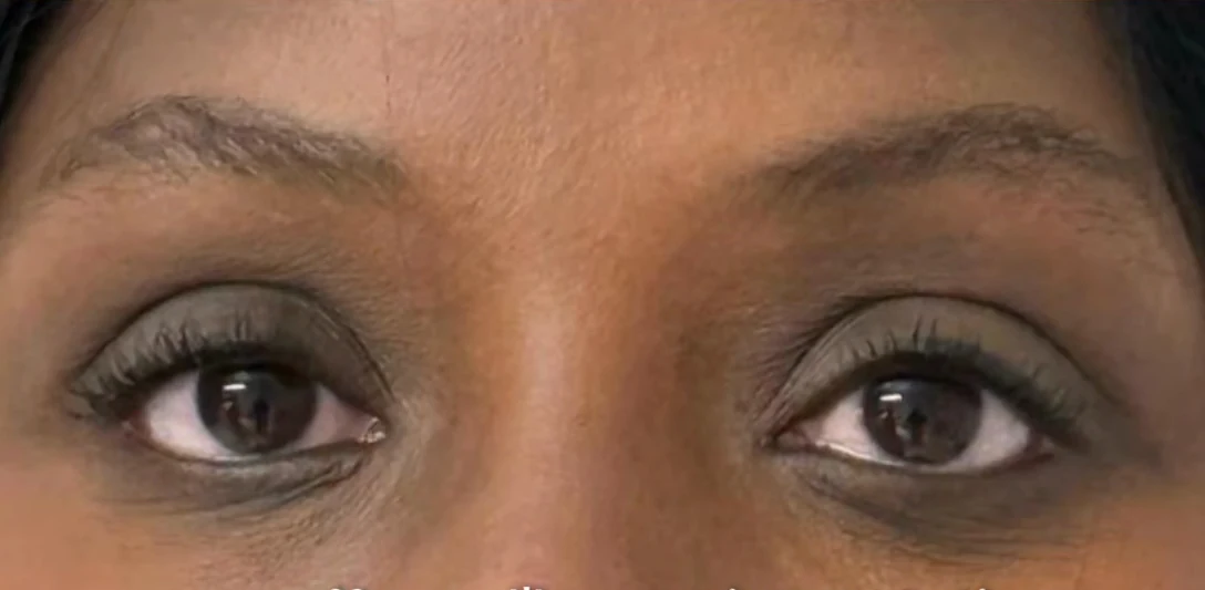 After: Nanofat for pigmented dark circles, dark skin