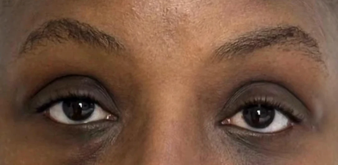Before: Nanofat for pigmented dark circles, dark skin