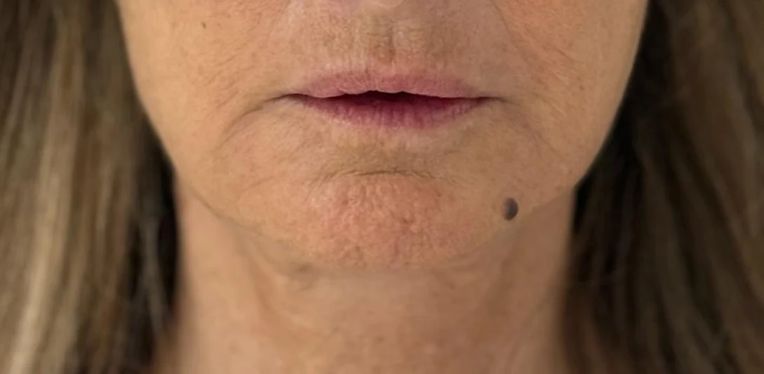 After: Hollow eyes and volume restoration with fat · lower face