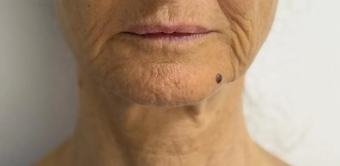 Before: Hollow eyes and volume restoration with fat · lower face