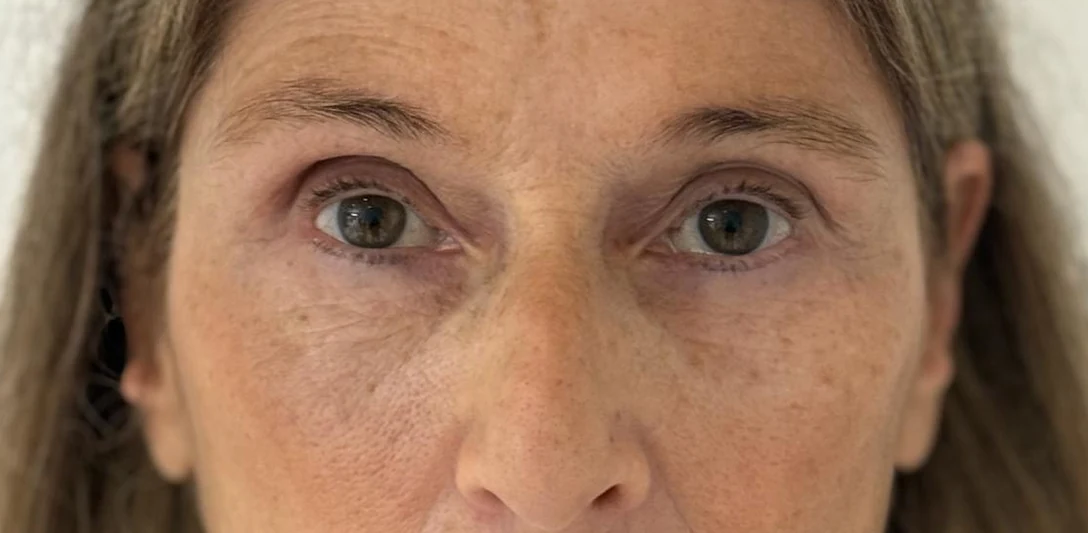 After: Hollow eyes and volume restoration with fat · front view