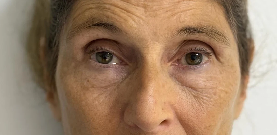 Before: Hollow eyes and volume restoration with fat · front view