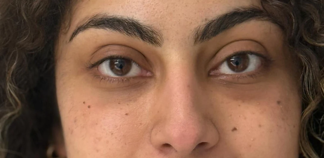 Après : Traitement de l’œil creux par injection de graisse