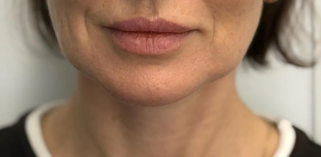 After: Restoring the facial oval with fat