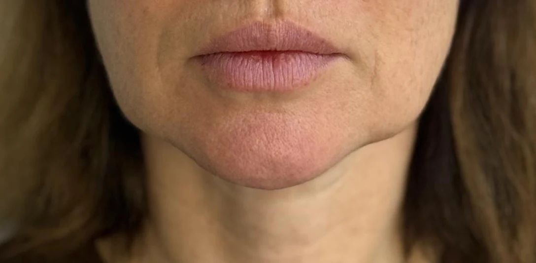 Before: Restoring the facial oval with fat