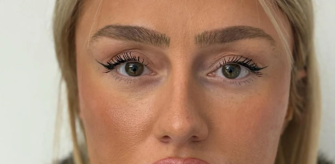 After: Bags removed and dark circles filled with fat