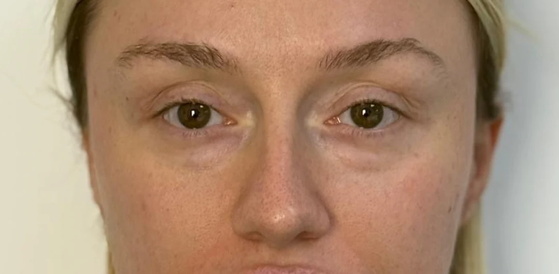 Before: Bags removed and dark circles filled with fat