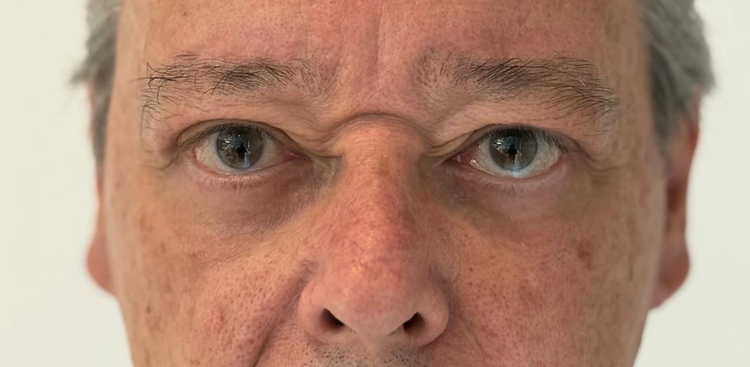 After: Under-eye bags
