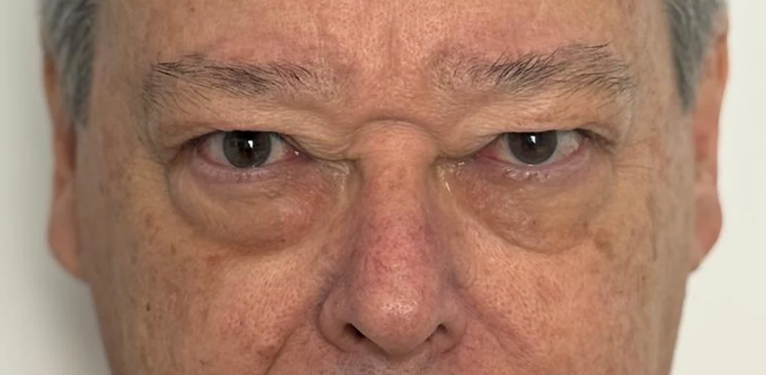 Before: Under-eye bags