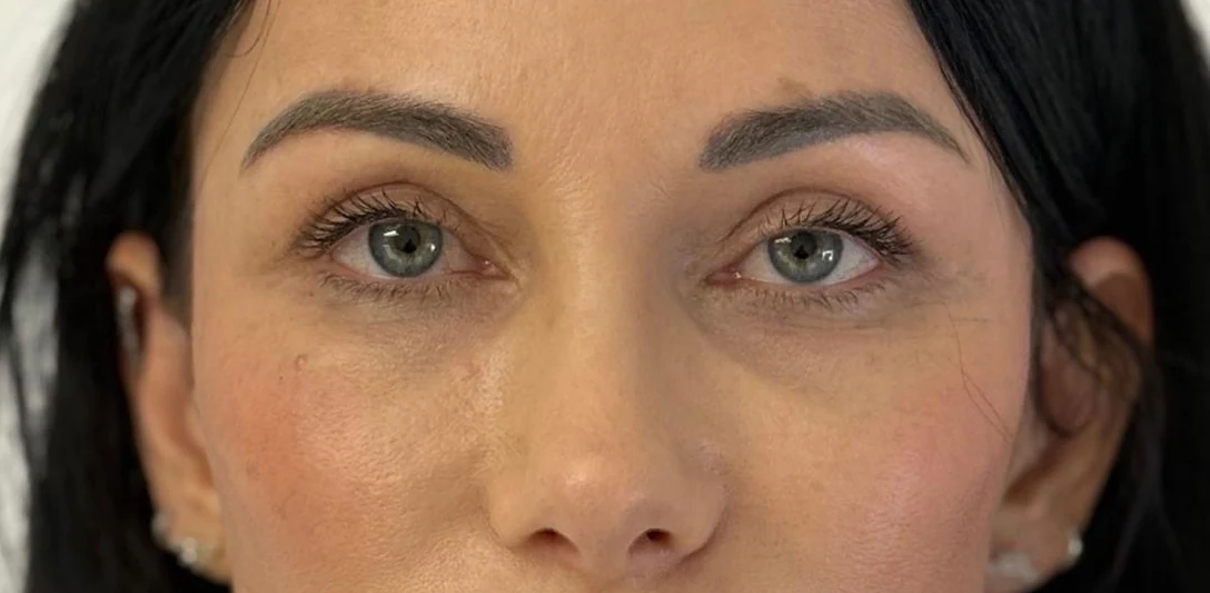After: Eye rejuvenation and ptosis
