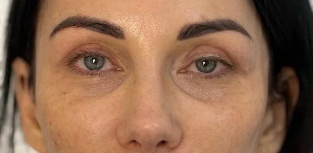 Before: Eye rejuvenation and ptosis
