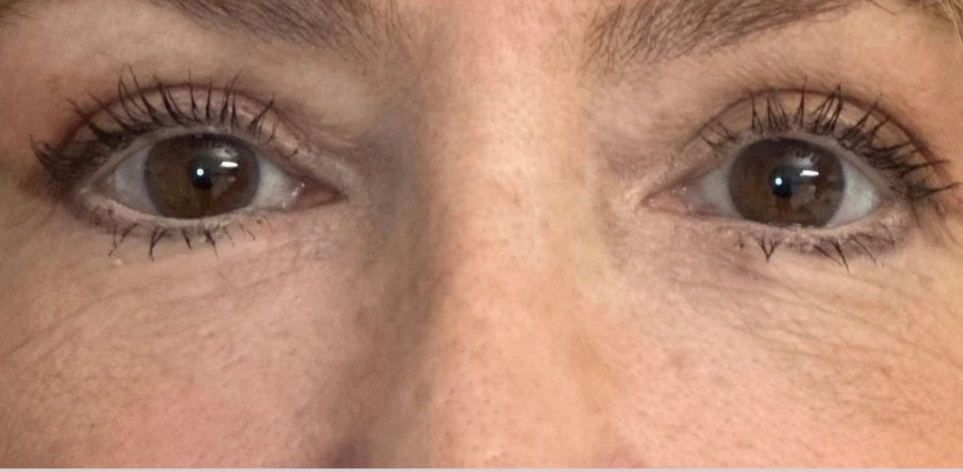 After: Correcting a hollowed eye area