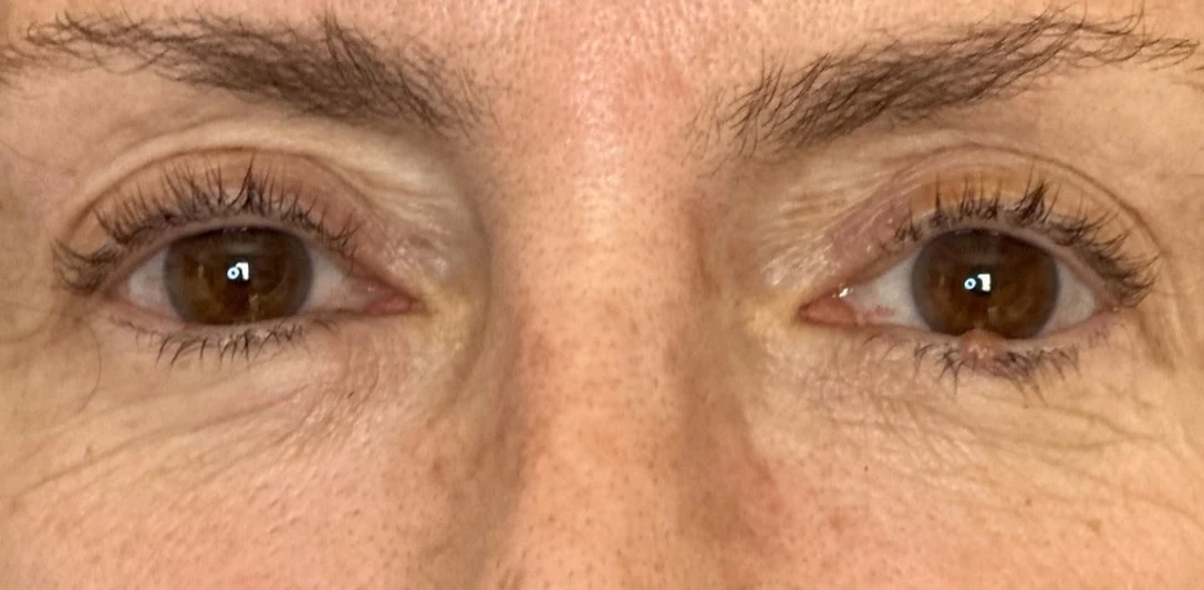 Before: Correcting a hollowed eye area