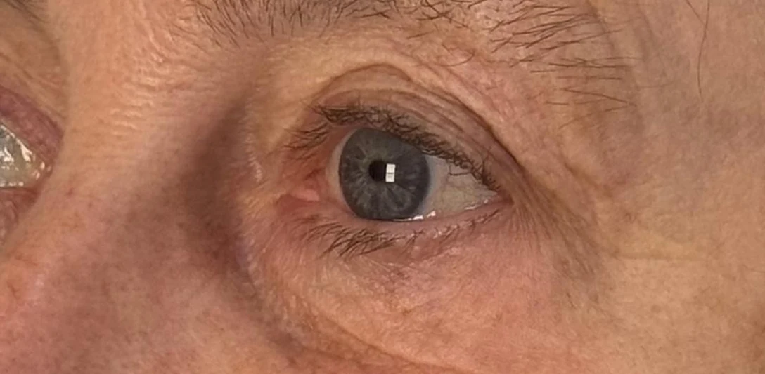 Before: Correcting a hollowed eye area (second case)