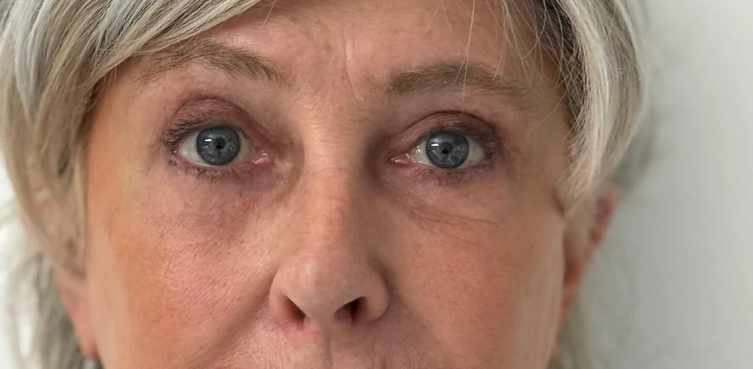 Après : Reprise d’un regard creusé (deuxième cas) · vue de face