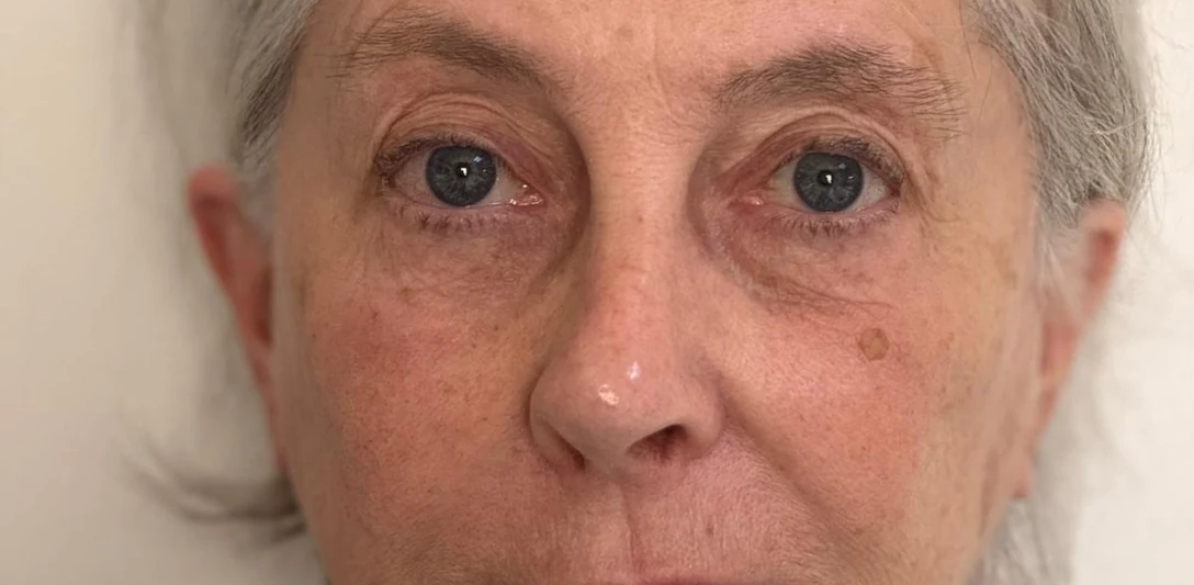 Before: Correcting a hollowed eye area (second case)