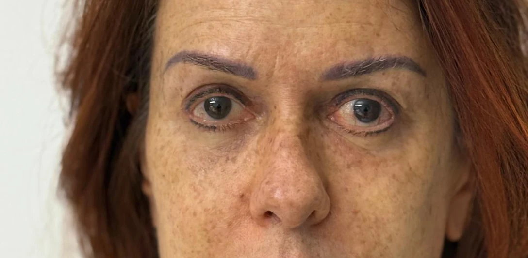 After: Correcting a hollowed eye area (third case) · front view