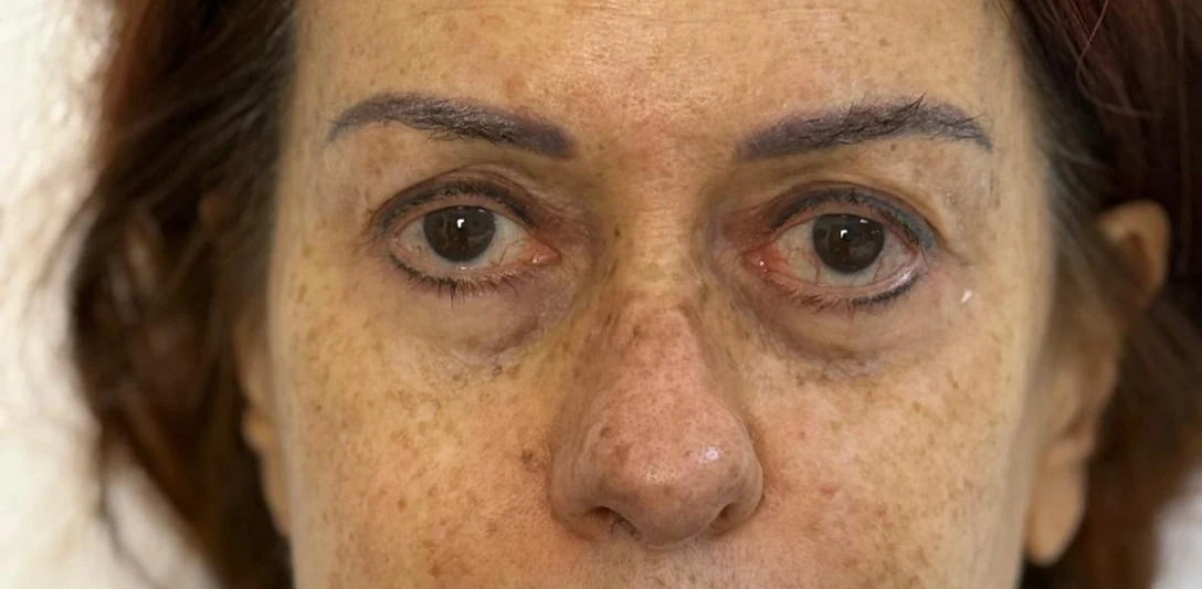 Before: Correcting a hollowed eye area (third case) · front view