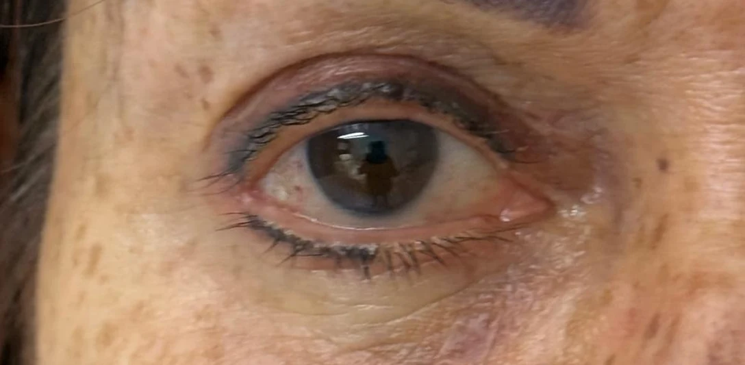 Après : Reprise d’un regard creusé (troisième cas) · œil droit