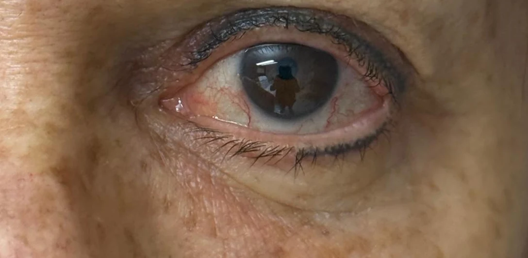 After: Correcting a hollowed eye area (third case) · left eye