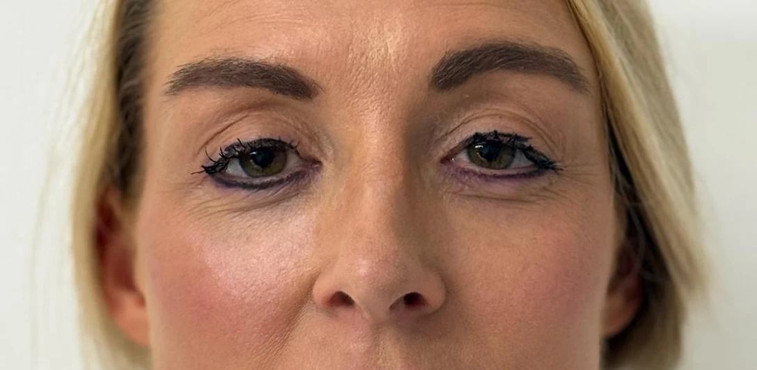 After: Sculpting the eye area