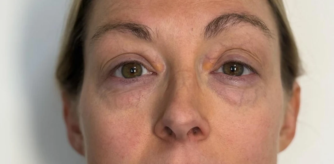 Before: Sculpting the eye area