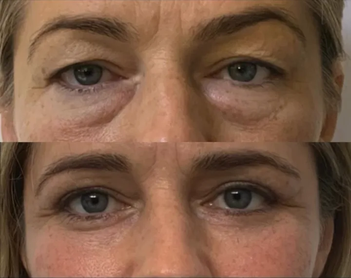 Before (top) and after (bottom), case published by Dr Hayot on July 8, 2024