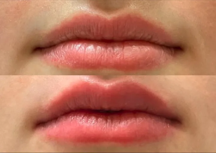 Before (top) and after (bottom), case published by Dr Hayot on September 13, 2024