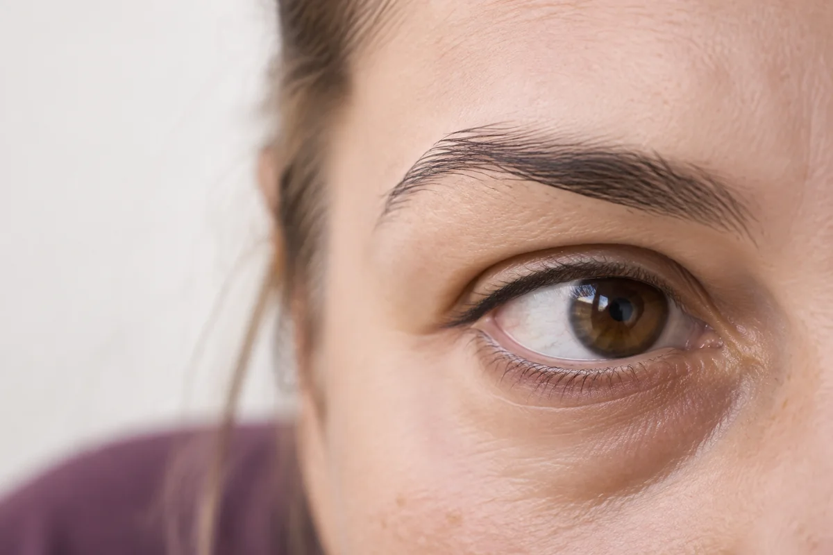 Poches malaires : pourquoi les injections ne suffisent pas