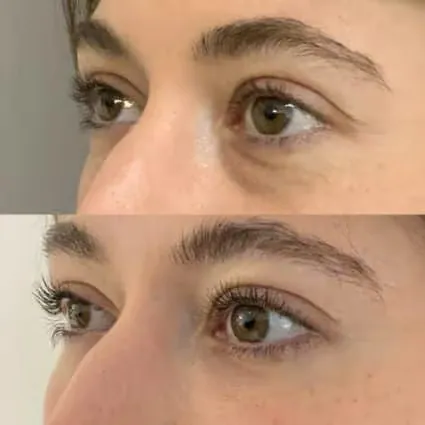 Before and after: Fat injection