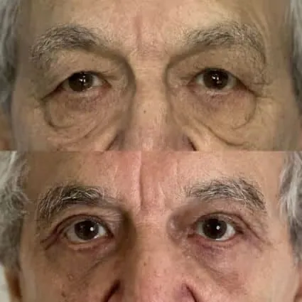Before and after: Fat injection