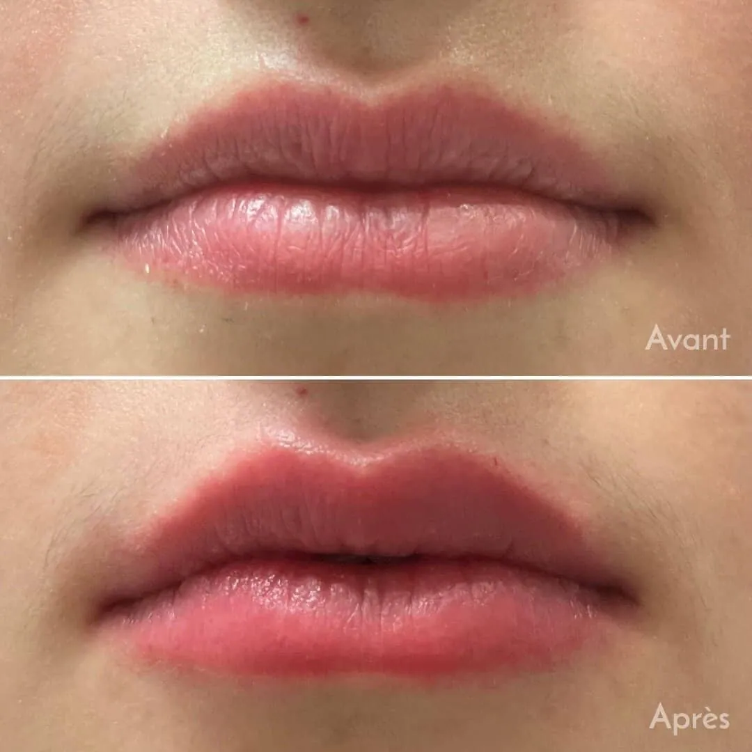 Before and after: Hyaluronic acid lip injections