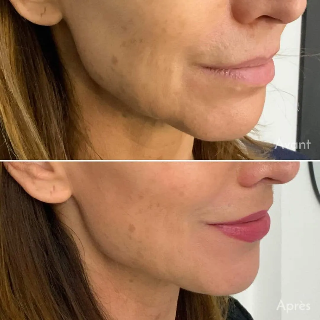 Before and after: Micro lipostructure